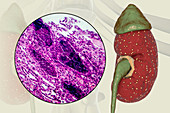 Acute pyelonephritis, illustration and light micrograph