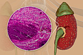 Acute pyelonephritis, illustration and light micrograph