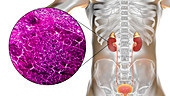 Acute pyelonephritis, illustration and light micrograph