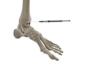 Ankle injection, illustration