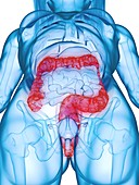 Diseased colon, illustration