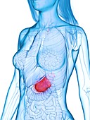 Diseased stomach, illustration