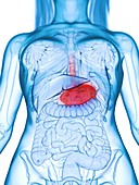 Diseased stomach, illustration