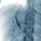 Portal vein surgery, X-ray