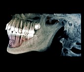 Jaw tumour, CT scan