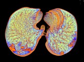 Lungs affected by Covid-19 atypical pneumonia, 3d CT scan