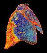 Lungs affected by Covid-19 atypical pneumonia, 3d CT scan