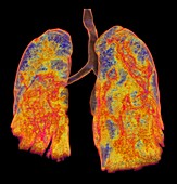 Lungs affected by Covid-19 atypical pneumonia, 3d CT scan