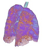 Lungs affected by Covid-19 atypical pneumonia, 3d CT scan