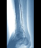Narrowed leg artery, X-ray