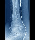 Narrowed leg artery treatment, X-ray