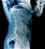 Healthy lower spine, X-ray
