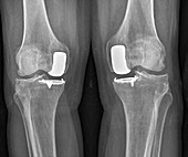 Partial knee replacement, X-ray