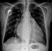 Heart failure, X-ray