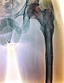 Healing broken hip, X-ray