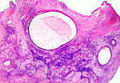 Human ovary cysts, light micrograph