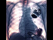 Pacemaker and heart pump, X-ray
