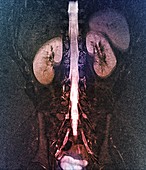 Tarlov spinal cysts, MRI scan