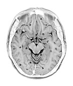 Cysticercosis of the brain, MRI scan