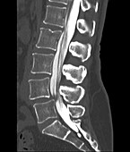 Herniated disc, CT scan