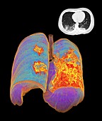 Lungs affected by Covid-19 atypical pneumonia, CT scans