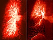 Pulmonary embolism and healthy lung, angiograms