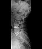 Intervertebral disc implants, X-ray