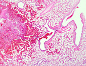 Lobar pneumonia red hepatization, light micrograph