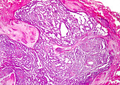 Inflamed human fallopian tube, light micrograph