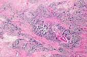 Invasive ductal carcinoma of the breast, light micrograph