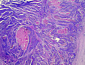 Oesophageal squamous cell carcinoma, light micrograph