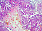 Adenomatous papilloma of the human rectum, light micrograph