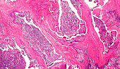 Human follicular thyroid carcinoma, light micrograph