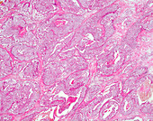 Human renal cell carcinoma, light micrograph