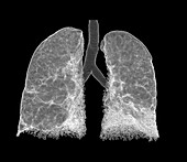Emphysema, CT scan