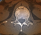 Fractured lumbar vertebra, CT scan