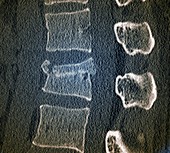 Fractured lumbar vertebra, CT scan