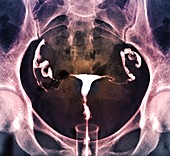 Healthy female reproductive system, X-ray