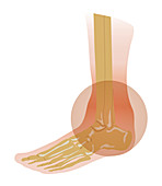 Inflamed ankle joint, illustration