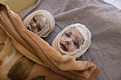 Burns patients, Afghanistan