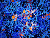 Amyloid and microglia cells in Alzheimer's, illustration