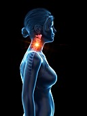 Woman with a painful neck, illustration