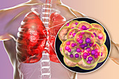 Coronavirus disease of the lungs, conceptual illustration