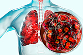 Coronavirus disease of the lungs, conceptual illustration