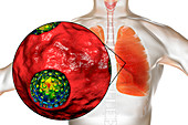 Coronavirus disease of the lungs, conceptual illustration