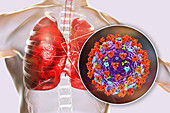 Coronavirus disease of the lungs, conceptual illustration