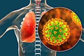 Coronavirus disease of the lungs, conceptual illustration