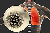 Coronavirus disease of the lungs, conceptual illustration