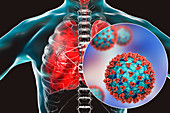 Coronavirus disease of the lungs, conceptual illustration