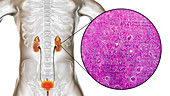 Chronic kidney disease, illustration and light micrograph